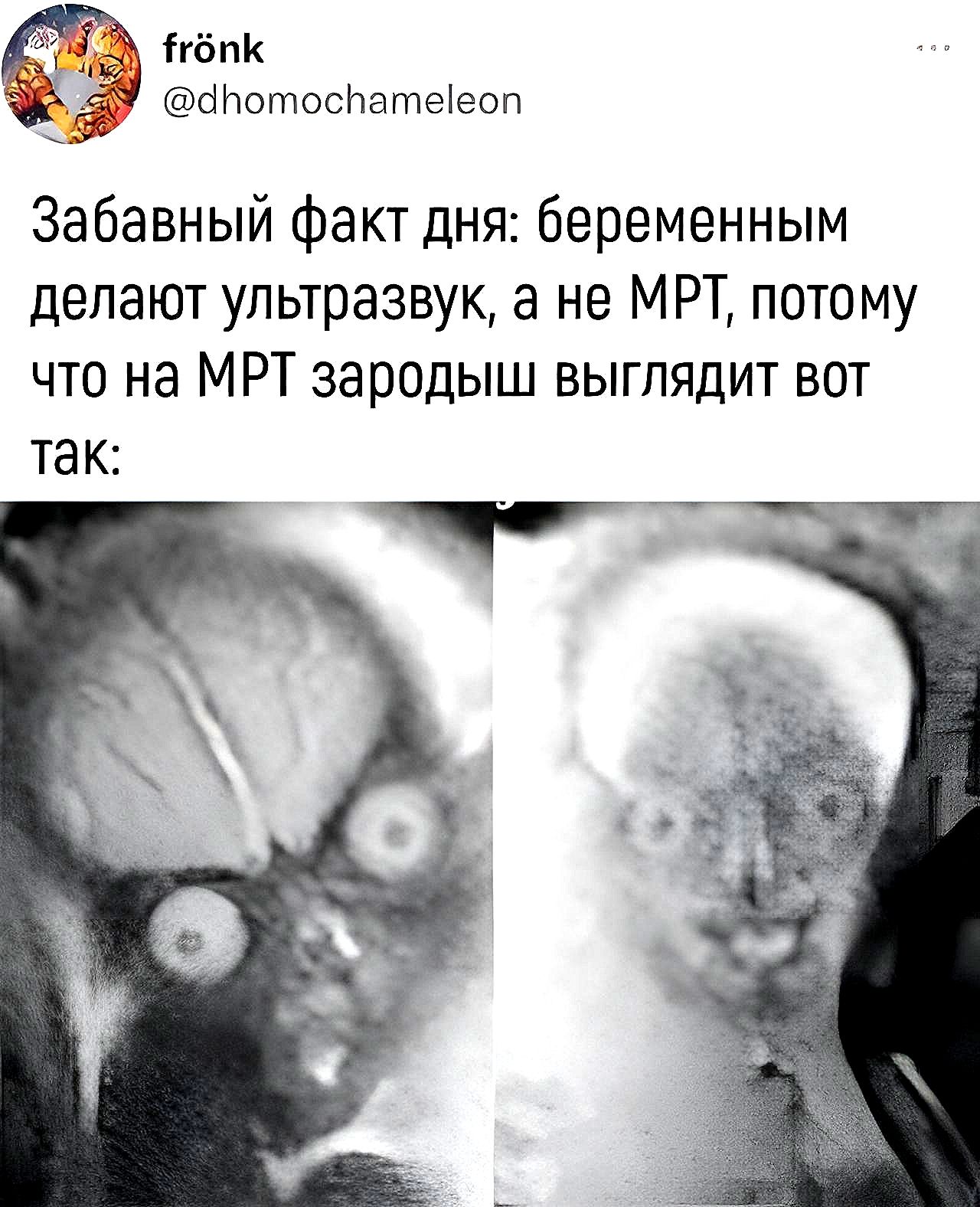 ігёпК сінотшснатеіеоп Забавный Факт дня беременным делают ультразвук а не МРТ потому что на МРТ зародыш выглядит вот так