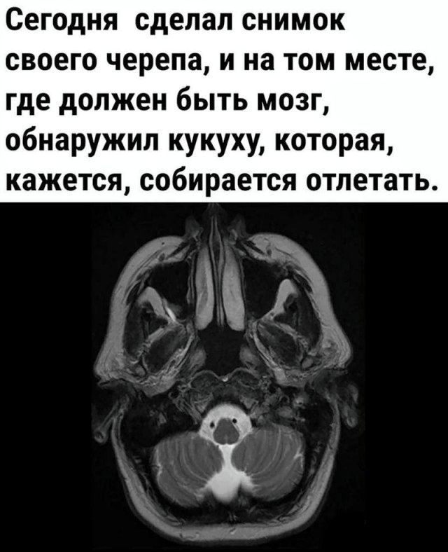 Сегодня сделал снимок своего черепа и на том месте где должен быть мозг обнаружил кукуху которая кажется собирается отлетать