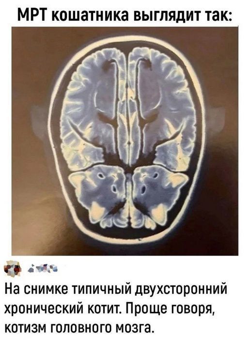 МРТ кошатника выглядит так:
На снимкеtypичныйдвухсторонний хронический котит. Проще говоря, котизм головного мозга.