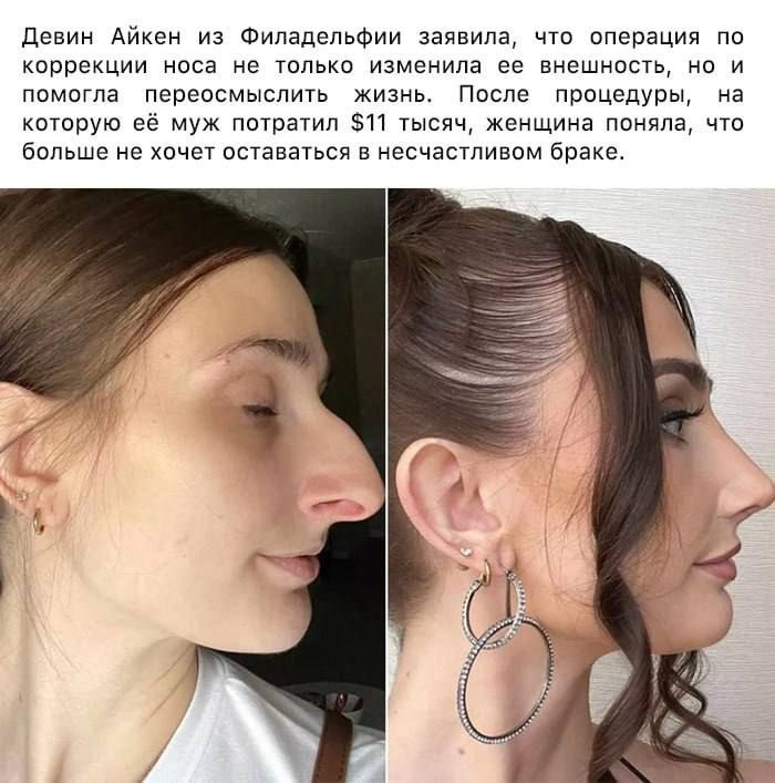 Девин Айкен из Филадельфии заявила, что операция по коррекции носа не только изменила её внешность, но и помогла переосмыслить жизнь. После процедуры, на которую её муж потратил $11 тысяч, женщина поняла, что больше не хочет оставаться в несчастливом браке.