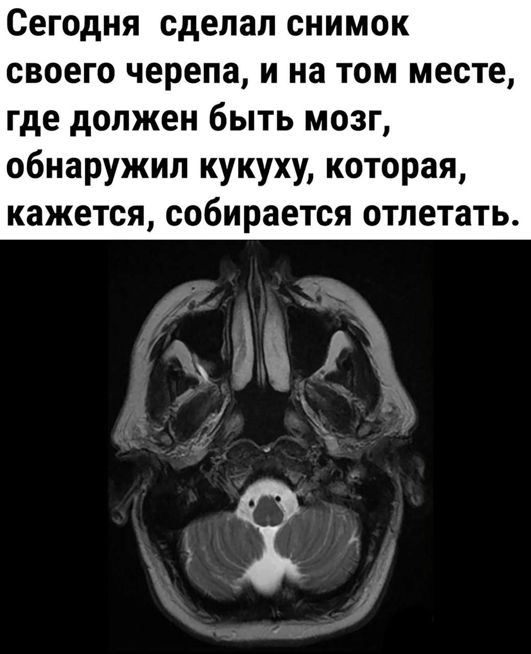 Сегодня сделал снимок своего черепа и на том месте где должен быть мозг обнаружил кукуху которая кажется собирается отлетать