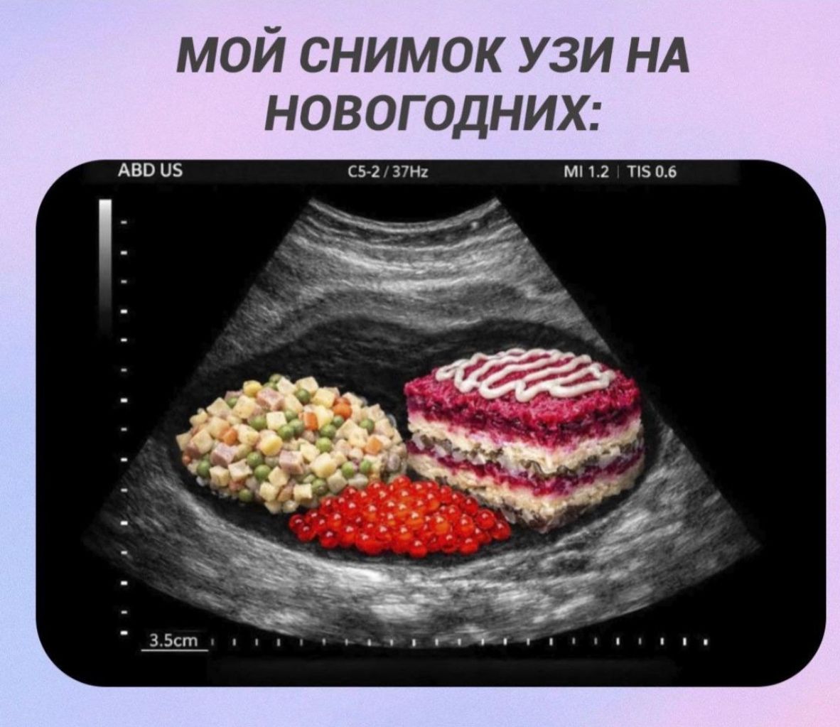 МОЙ СНИМОК УЗИ НА НОВОГОДНИХ: