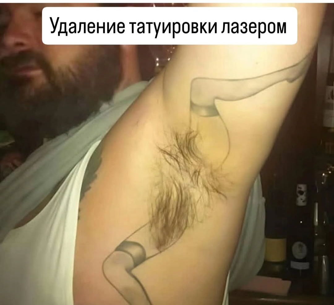 Удаление татуировки лазером