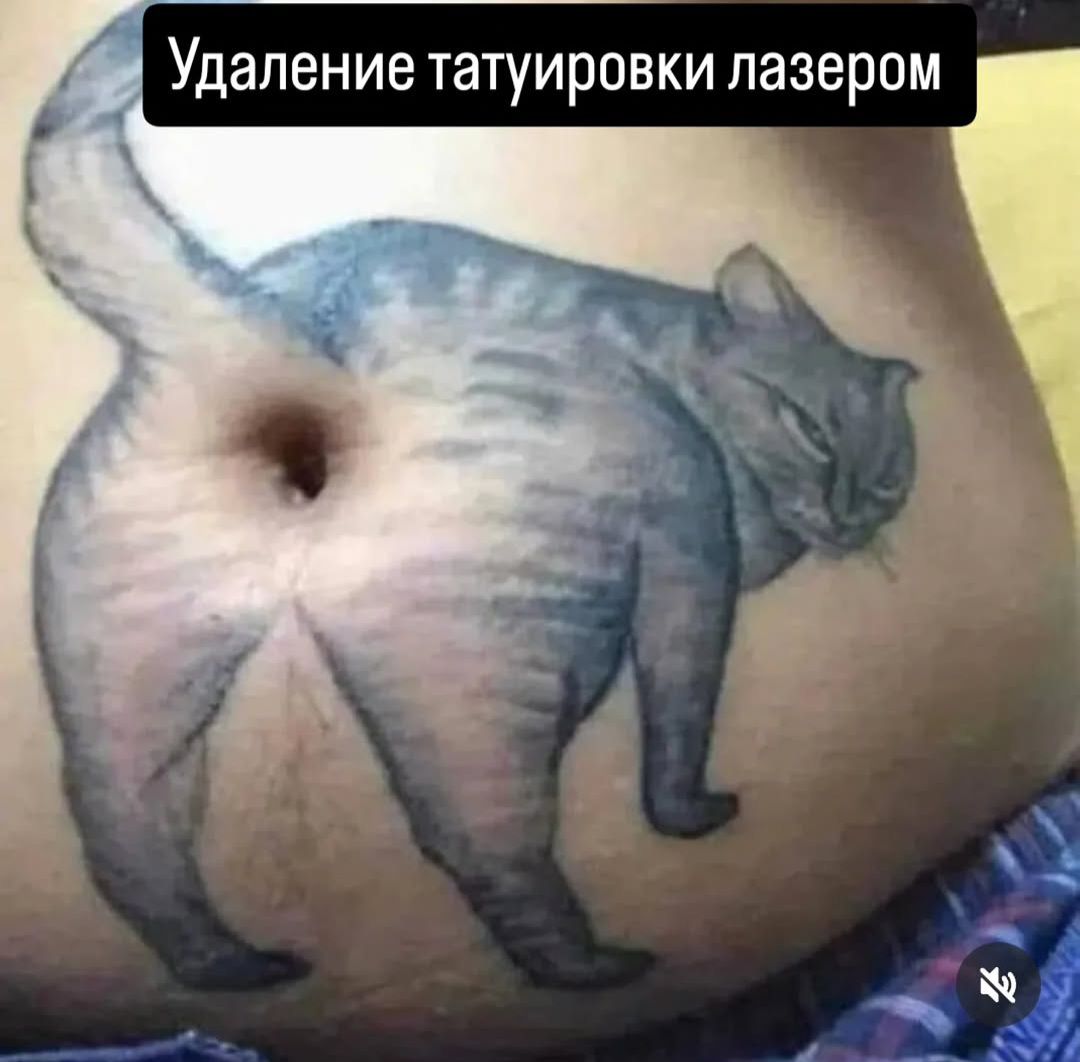 Удаление татуировки лазером