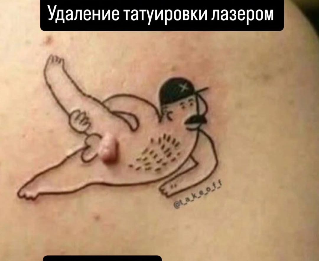 Удаление татуировки лазером
