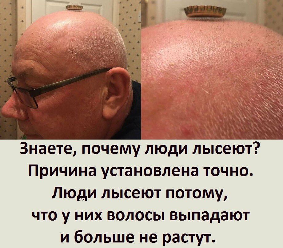 Знаете, почему люди лысеют? Причина установлена точно. Люди лысеют потому, что у них волосы выпадают и больше не растут.