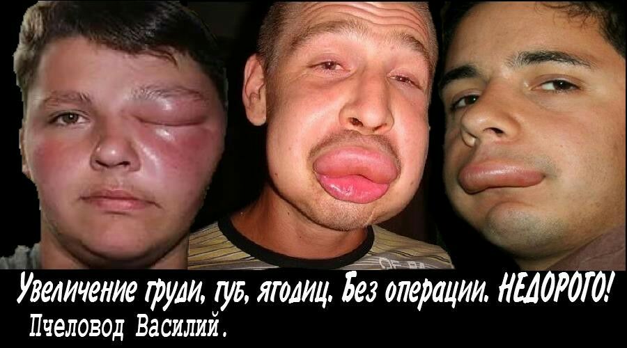 1д_ Увеличение рули ув ягодиц Без операции НЫдРдУд Пчеловод Василий