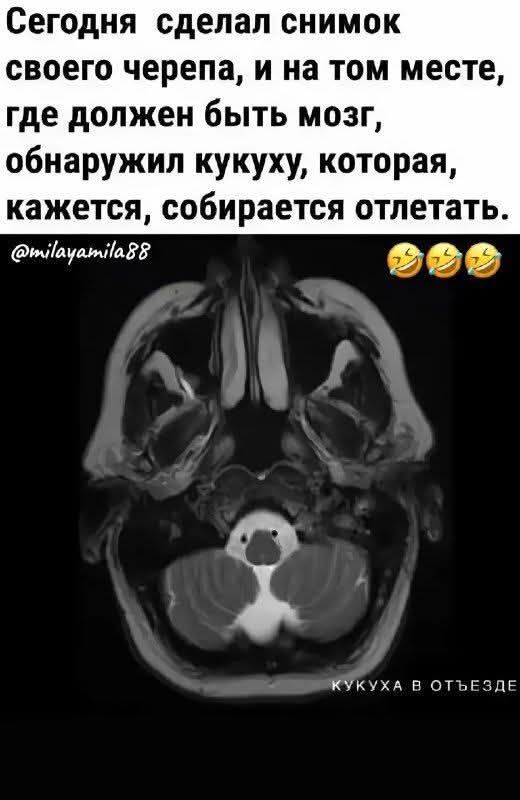 Сегодня сделал снимок своего черепа, и на том месте, где должен быть мозг, обнаружил кукуху, которая, кажется, собирается улетать.