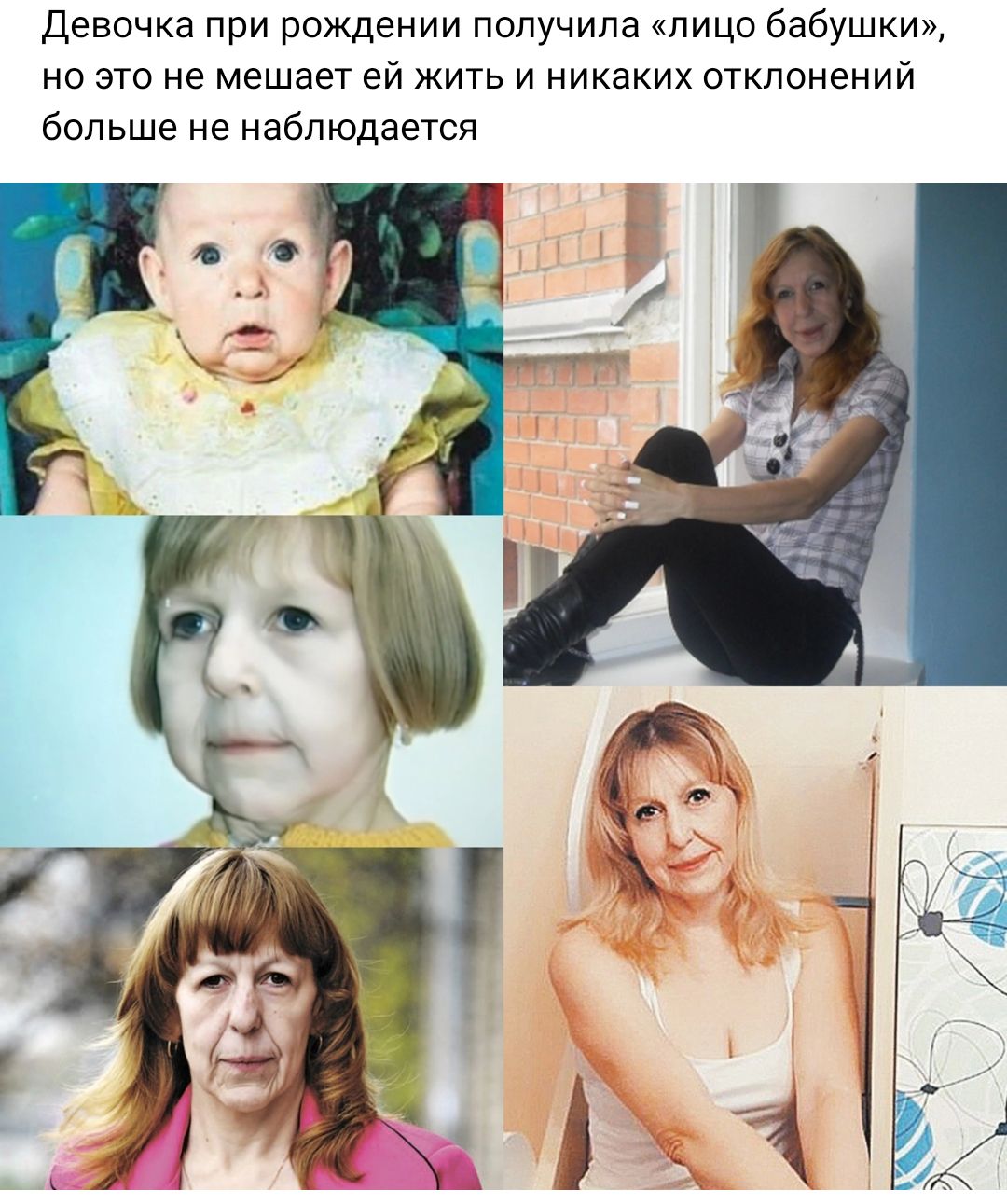 Девочка при рождении получила пицо бабушки но это не мешает ей жить и никаких отклонений больше не наблюдается
