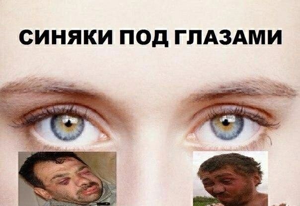 СИНЯКИ ПОД ГЛАЗАМИ