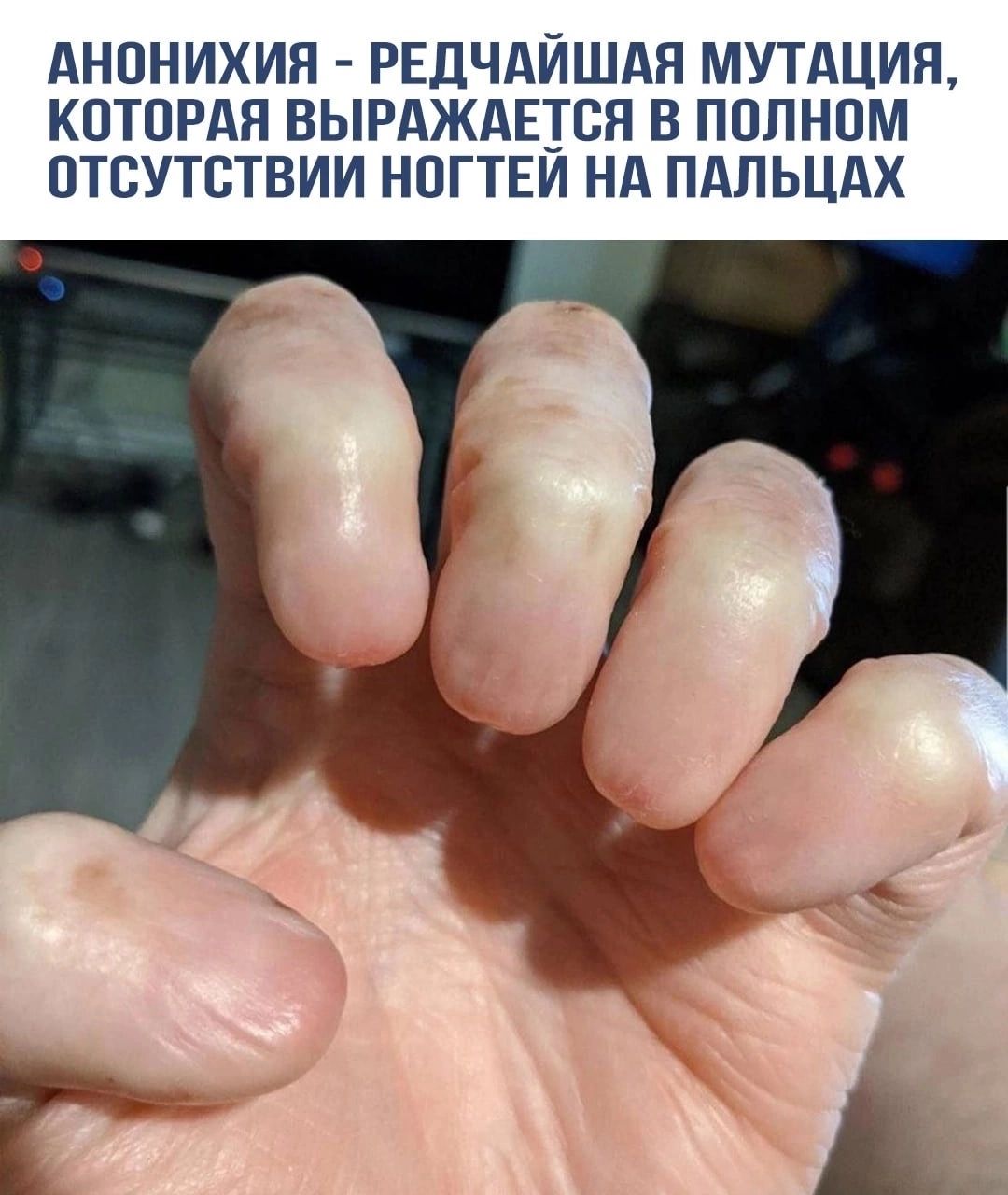 АНОНИХИЯ РЕДЧАЙШАН МУТАЦИЯ КПТПРАЯ ВЫРАЖАЕТЕЯ В ППЛНПМ ОТСУТСТВИИ НПГТЕИ НА ПАЛЬЦАХ