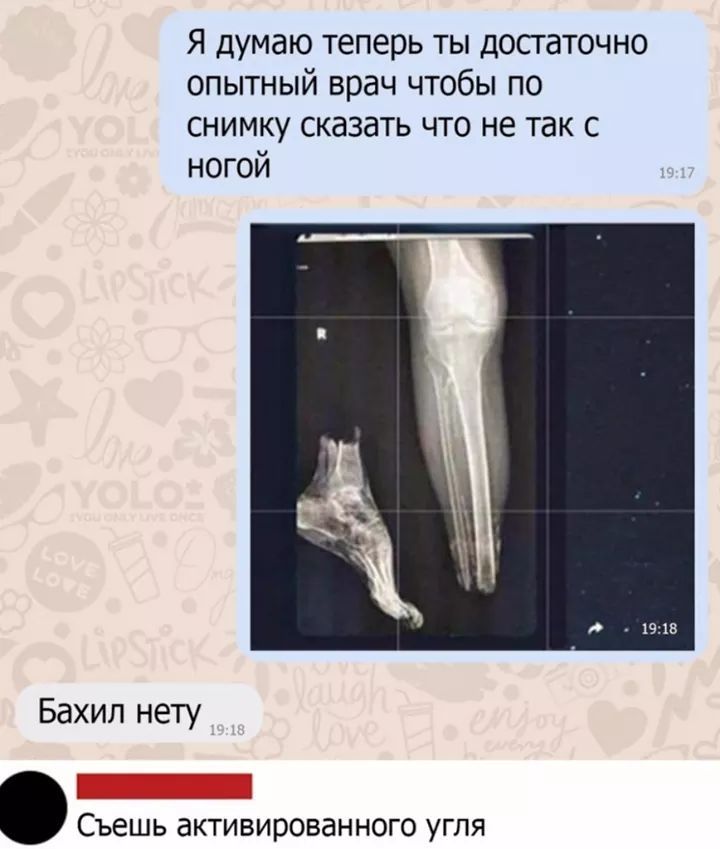 Я думаю теперь ты досгаточно опытный врач чтобы по снимку сказать что не так с ногой Бахил нету Съешь активированного угля