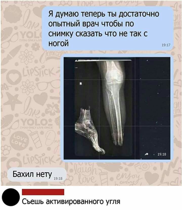 Я думаю теперь ты достаточно опытный врач чтобы по снимку сказать что не так с ногой Бахил нету 7 7 Съешь активированного угля