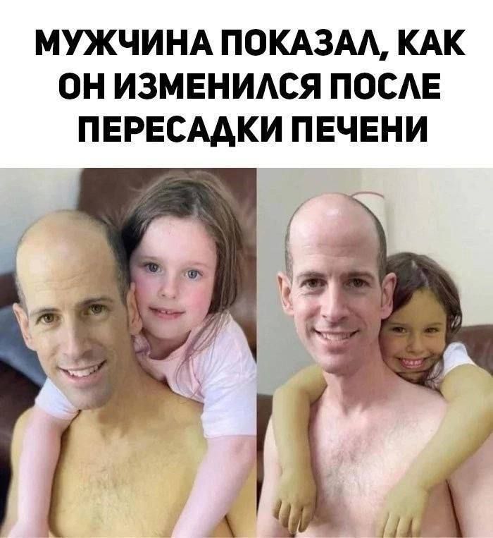 МУЖЧИНА ПОКАЗАА КАК ОН ИЗМЕНИАСЯ ПОСАЕ ПЕРЕСААКИ ПЕЧЕНИ