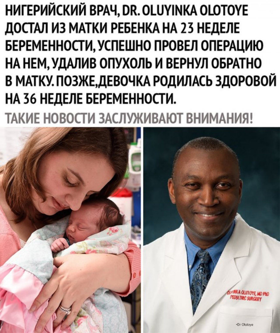 НИГЕРИЙСКИЙ ВРАЧ ОК ОШУМКА ООТОУЕ ДОСГАЛ ИЗ МАТКИ РЕБЕНКА НА 23 НЕДЕЛЕ БЕРЕМЕННОСГИУСПЕШНО ПРОВЕЛ ОПЕРАЦИЮ НА НЕМУДАЛИВ ОПУХОЛЬ И ВЕРНУЛ ОБРАТНО В МАТКУ ПОЗЖЕДЕВОЧКА РОДИЛАСЬ ЗДОРОВОЙ НА 36 НЕДЕЛЕ БЕРЕМЕННОСТИ ТАКИЕ НОВОСТИ ЗАСЛУЖИВАЮТ ВНИМАНИЯ