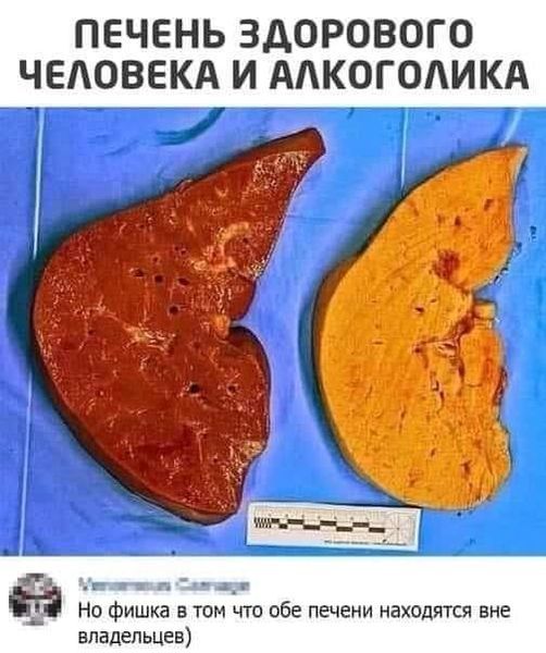 ПЕЧЕНЬ ЗДОРОВОГО ЧЕЛОВЕКА И ААКОГОАИКА в п и а_п Но Фишка в том что обе печени находится вне владельцев