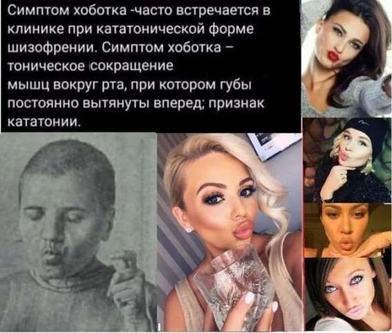 Симптом хоботка - часто встречается в клинике при кататонической форме шизофрении. Симптом хоботка - тоническое сокращение мышц вокруг рта, при котором губы постоянно вытянуты вперед; признак кататонии.