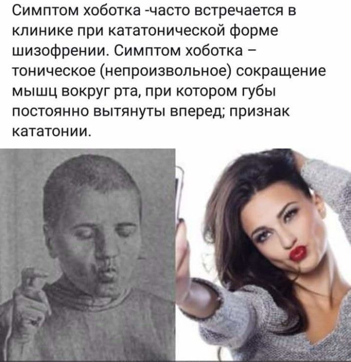 Симптом хоботка часто встречается в клинике при кататонической форме шизофрении Симптом хоботка тоническое непроизвольное сокращение мышц вокруг рта при котором губы постоянно вытянуты вперед признак кататонии