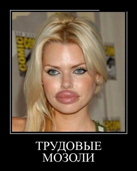 ТРУДОВЫЕ МОЗОЛИ
