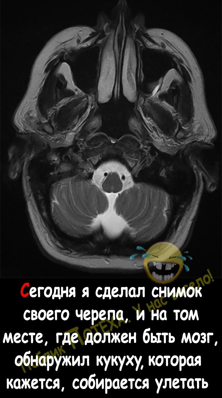 Сегодня я сделал снимок своего черепа и на том месте где должен быть мозг обнаружил кукуху которая кажется собирается улетать